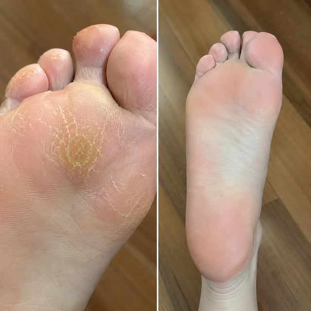 AIFUFAND customer foot care before and after result - After