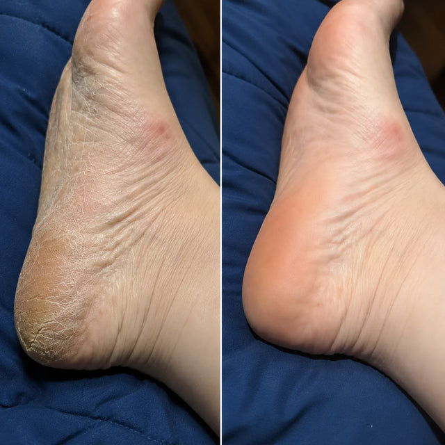 AIFUFAND customer foot care before and after result - After