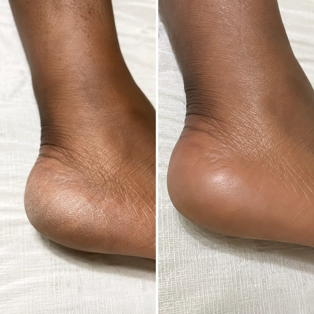 AIFUFAND customer foot care before and after result - After