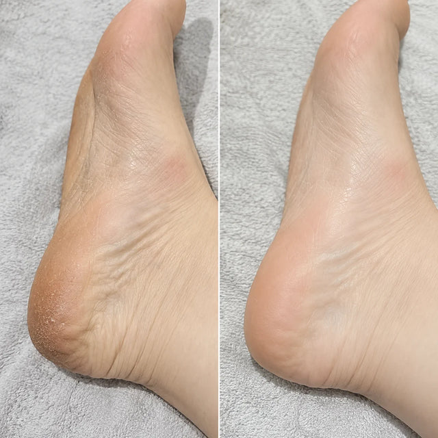 AIFUFAND customer foot care before and after result - After