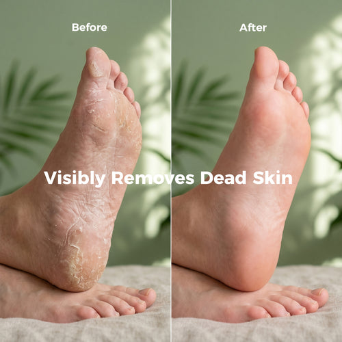 AIFUFAND Callus Remover Spray - At-Home Foot Callus Care