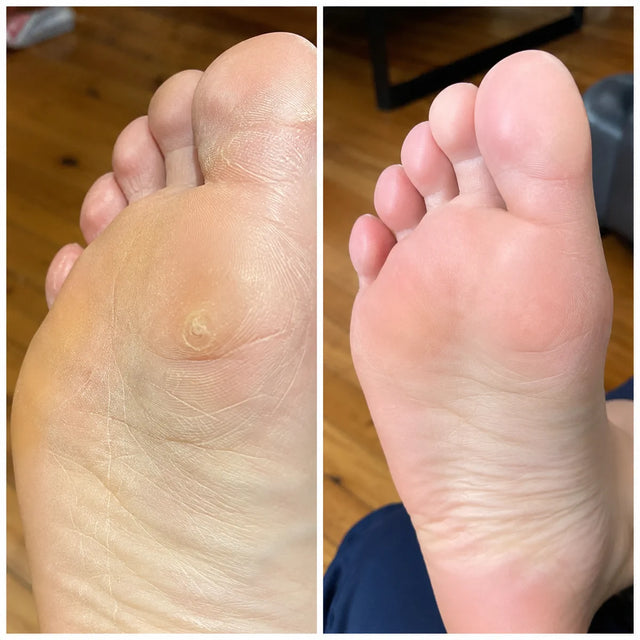 AIFUFAND customer foot care before and after result - After