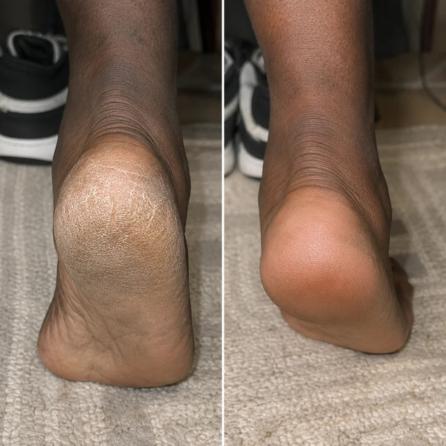 AIFUFAND customer foot care before and after result - After