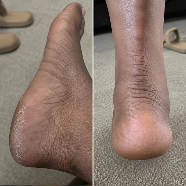 AIFUFAND customer foot care before and after result - After