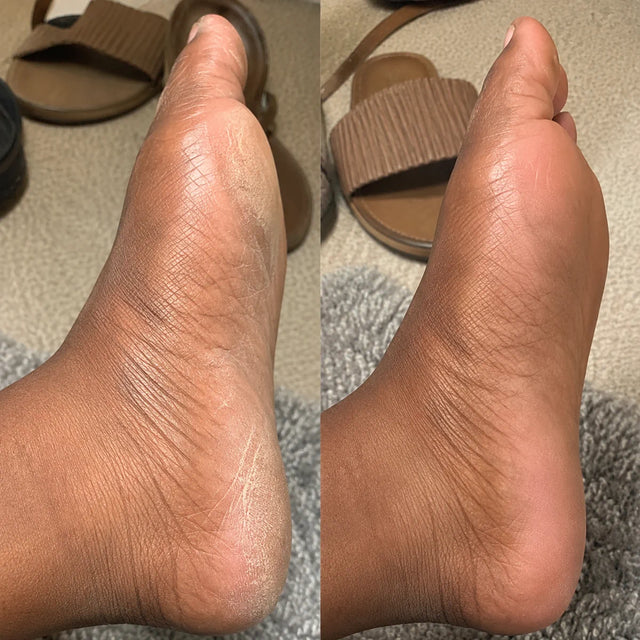 AIFUFAND customer foot care before and after result - After
