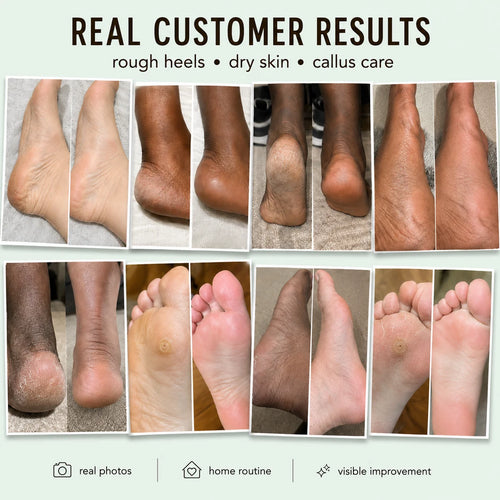 AIFUFAND Callus Remover Spray